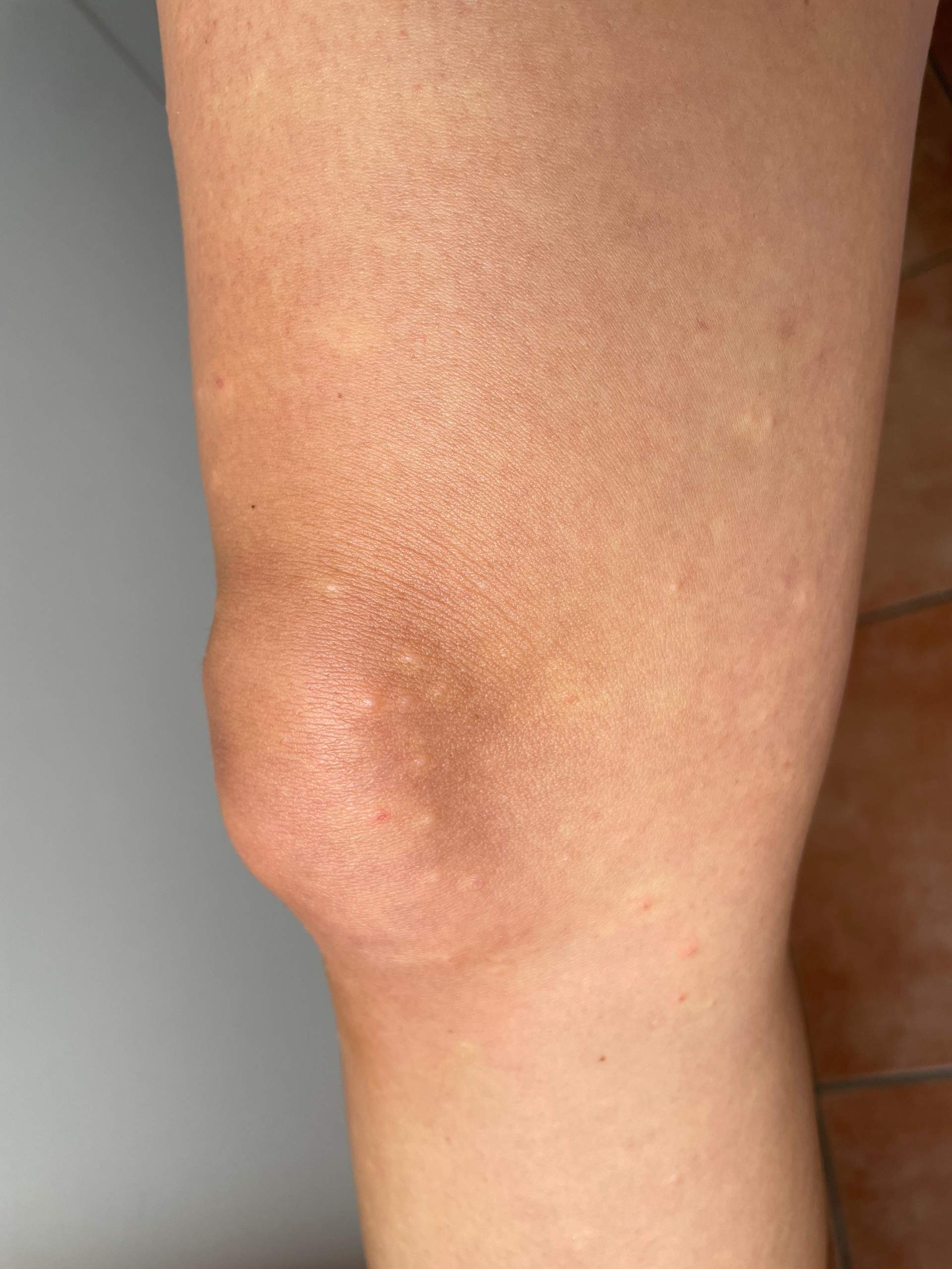 Was sind das für Stiche? (Haut, Stich)