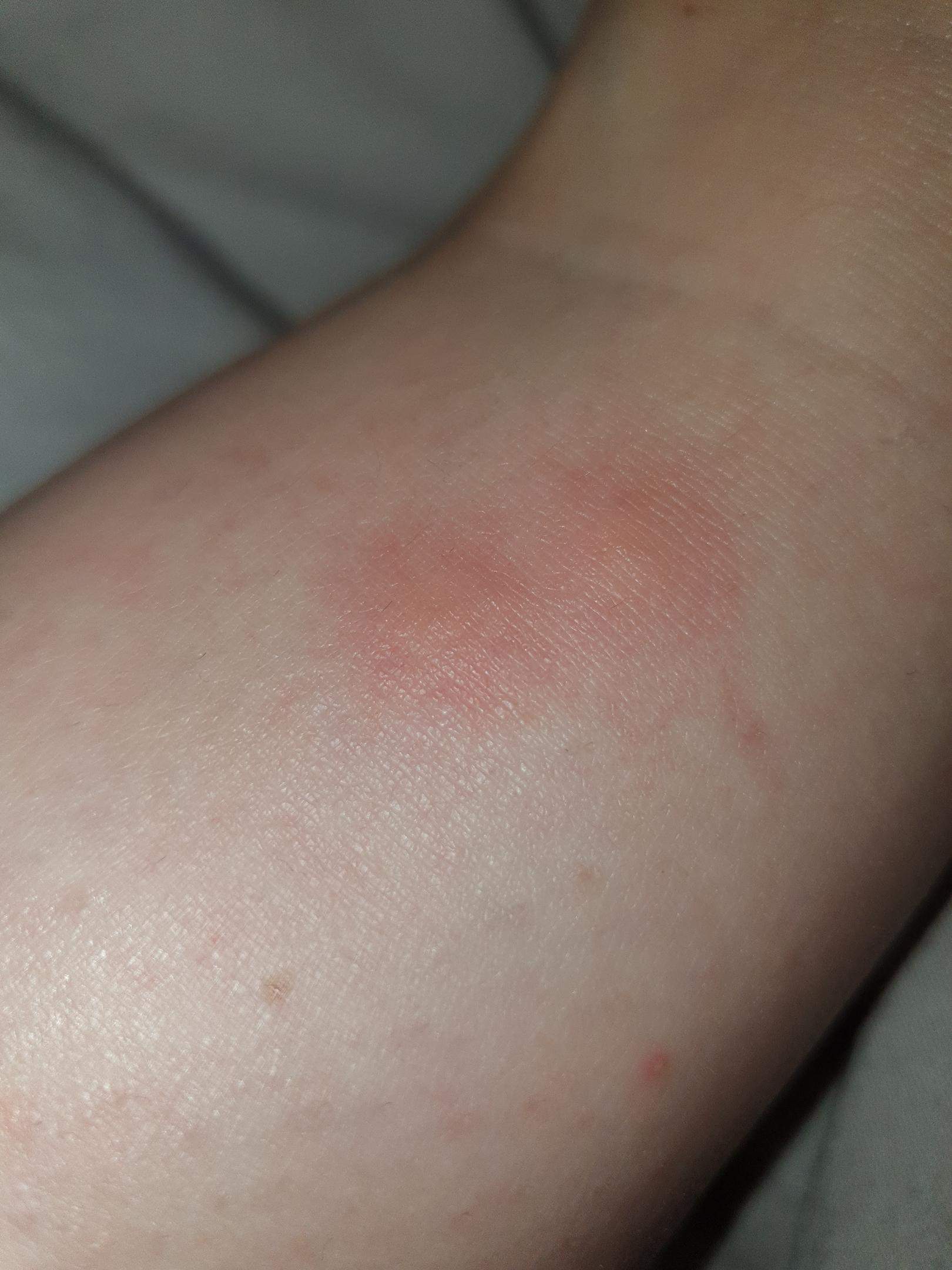 Was Sind Das Fur Stiche Jucken Schwellung Was Sind Das Fur Stiche Jucken Schwellung