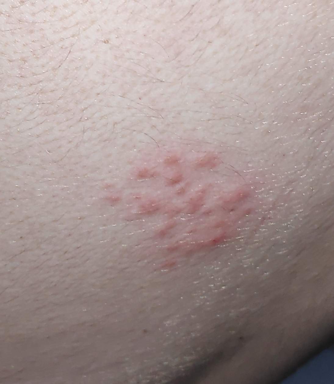 Was sind das für Stiche auf meinem Rücken? (Gesundheit und Medizin, Stich)