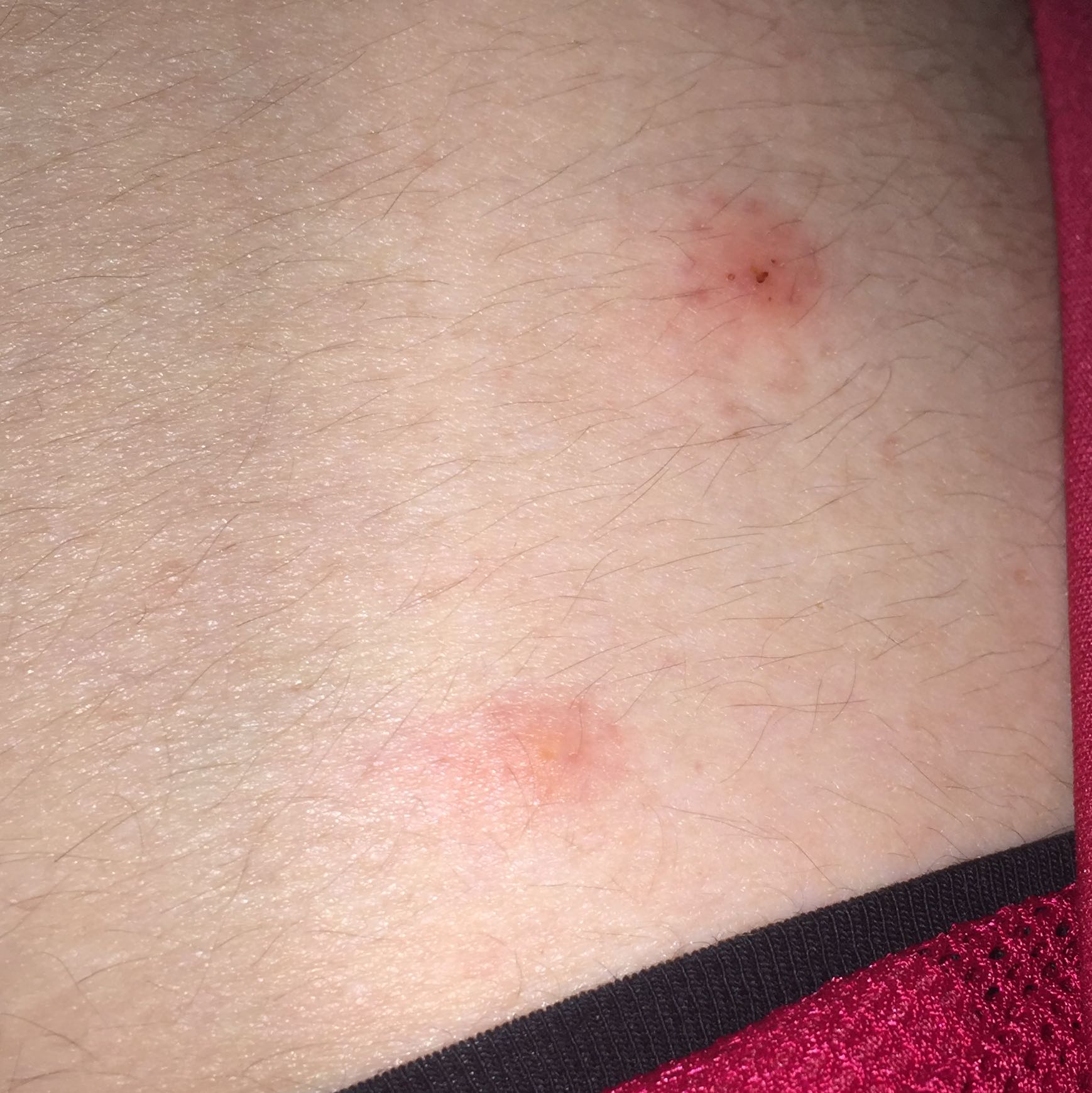 Was sind das für Stiche Bisse auf meinem Körper? (Haut, Insekten, Stich) Was sind das für Stiche Bisse auf meinem Körper? (Haut, Insekten, Stich)