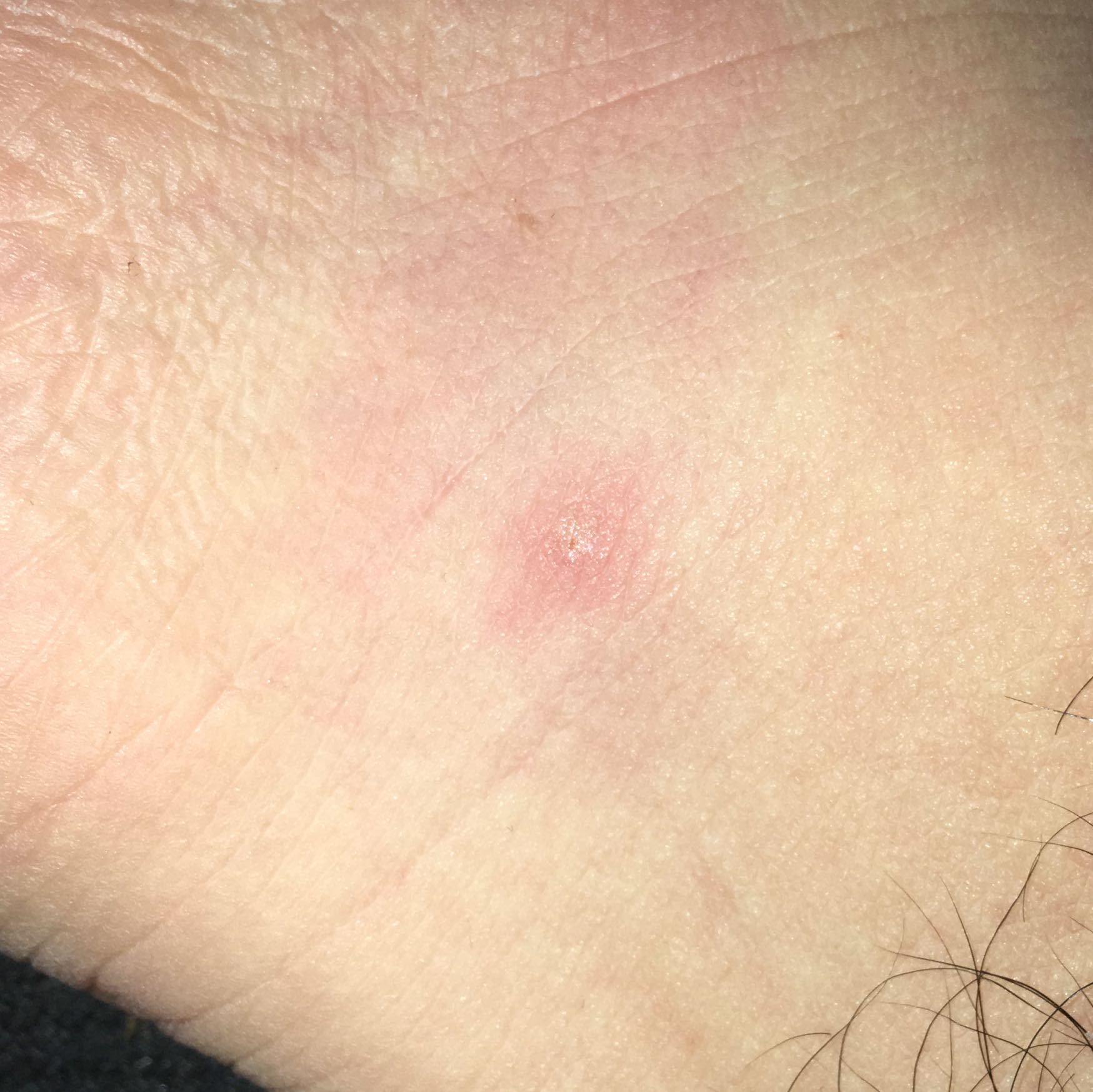 Was sind das für Stiche oder Bisse (Bilder)? (Gesundheit, Medizin, Tiere) Was sind das für Stiche oder Bisse (Bilder)? (Gesundheit, Medizin, Tiere)