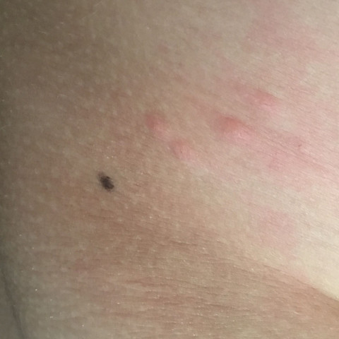 Was Sind Das Fur Stiche Oder Bisse Gesundheit Insekten Stich