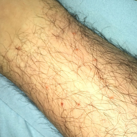 hier die bisse/stiche - (Allergie, Insekten, Stich)