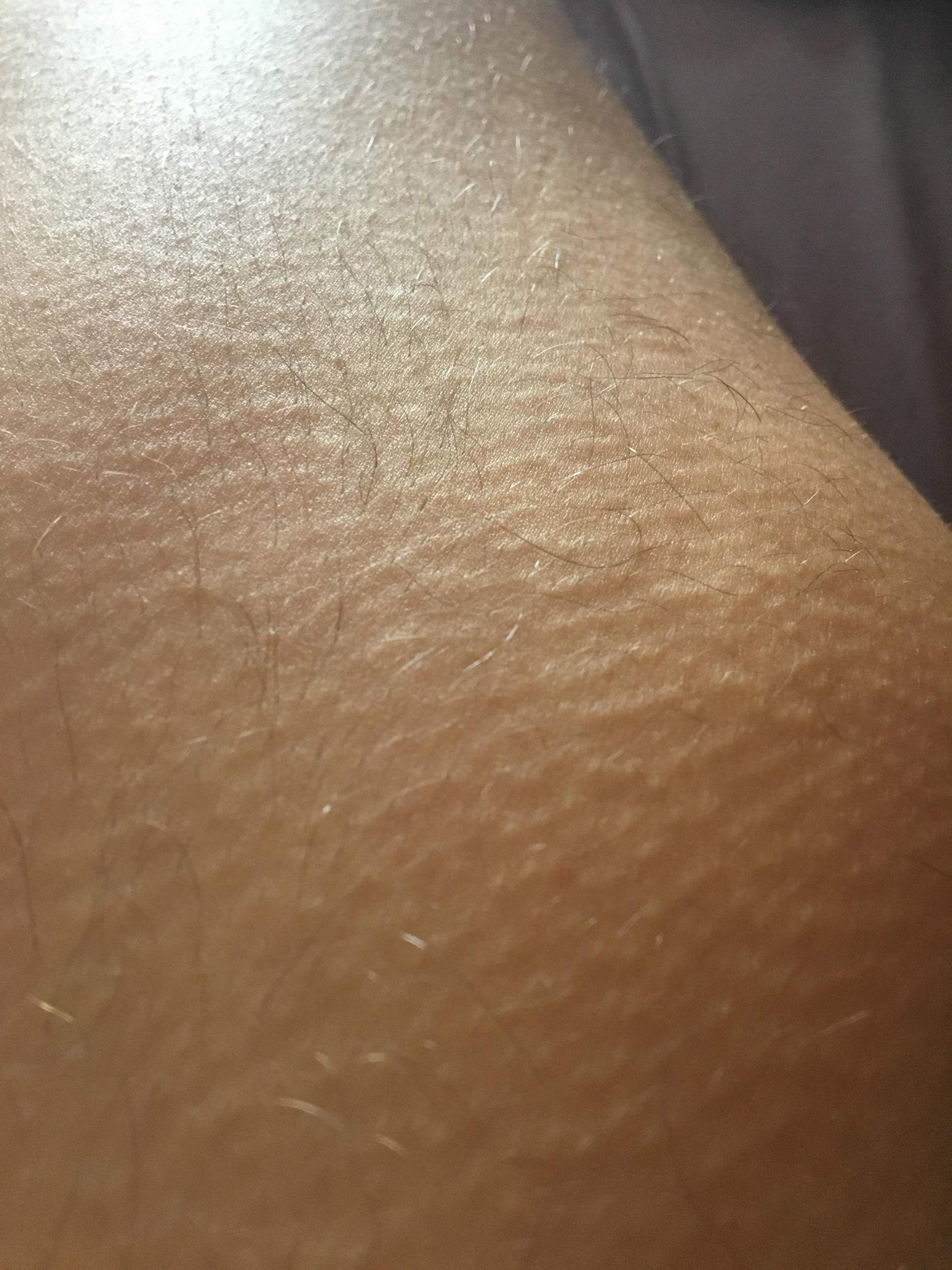 Was sind das für Striche an meinen Oberschenkeln? (Gesundheit und ...