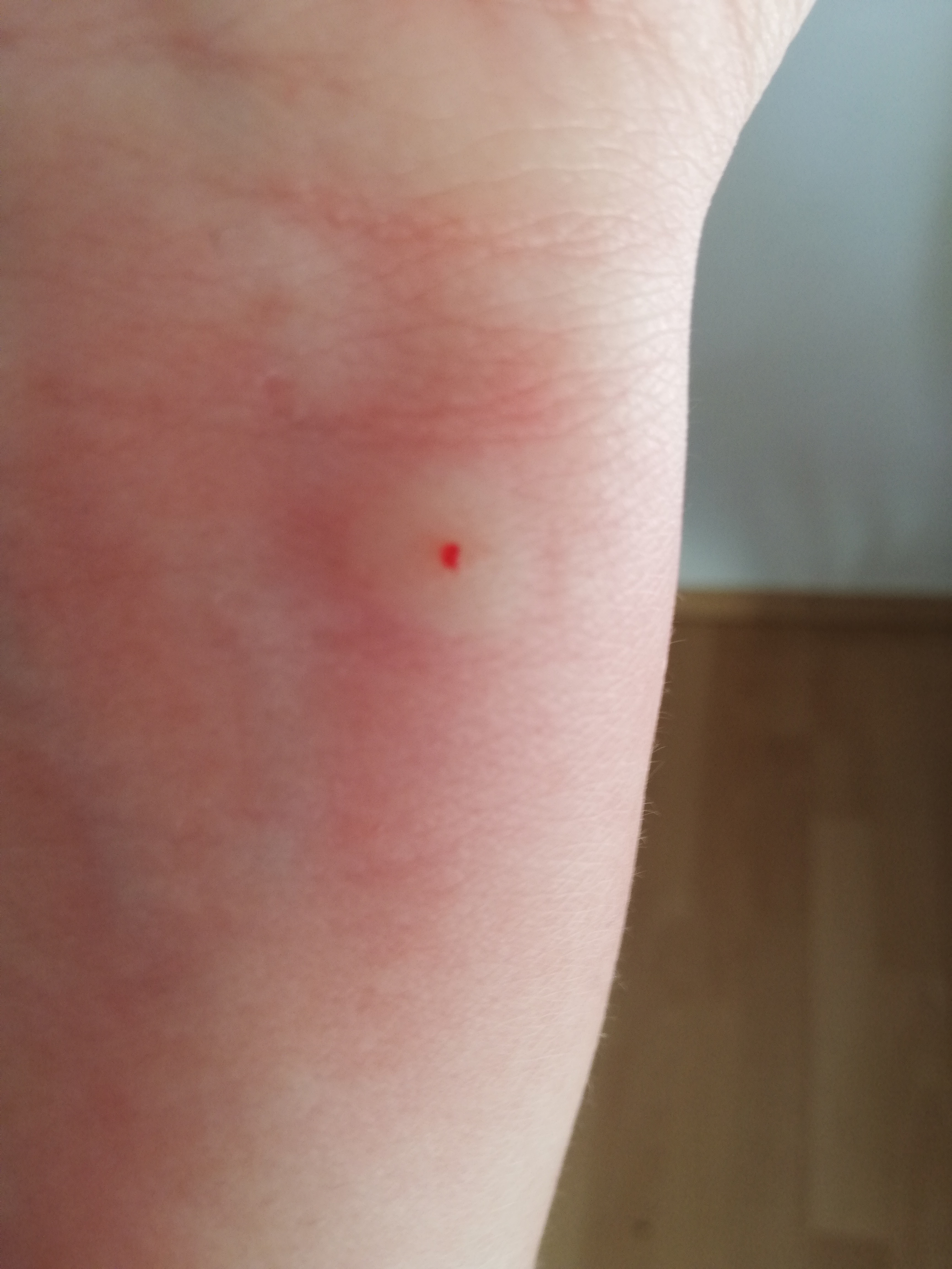 Was sind das für tägliche Stiche? (Gesundheit und Medizin, Stich, Bisse)