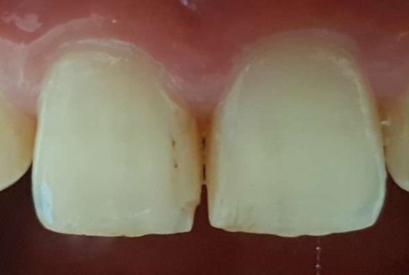Graue verfärbung zahn Zahn wird