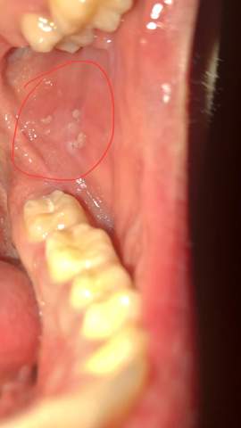 Was sind das für weiße Flecken in meinem Mund?