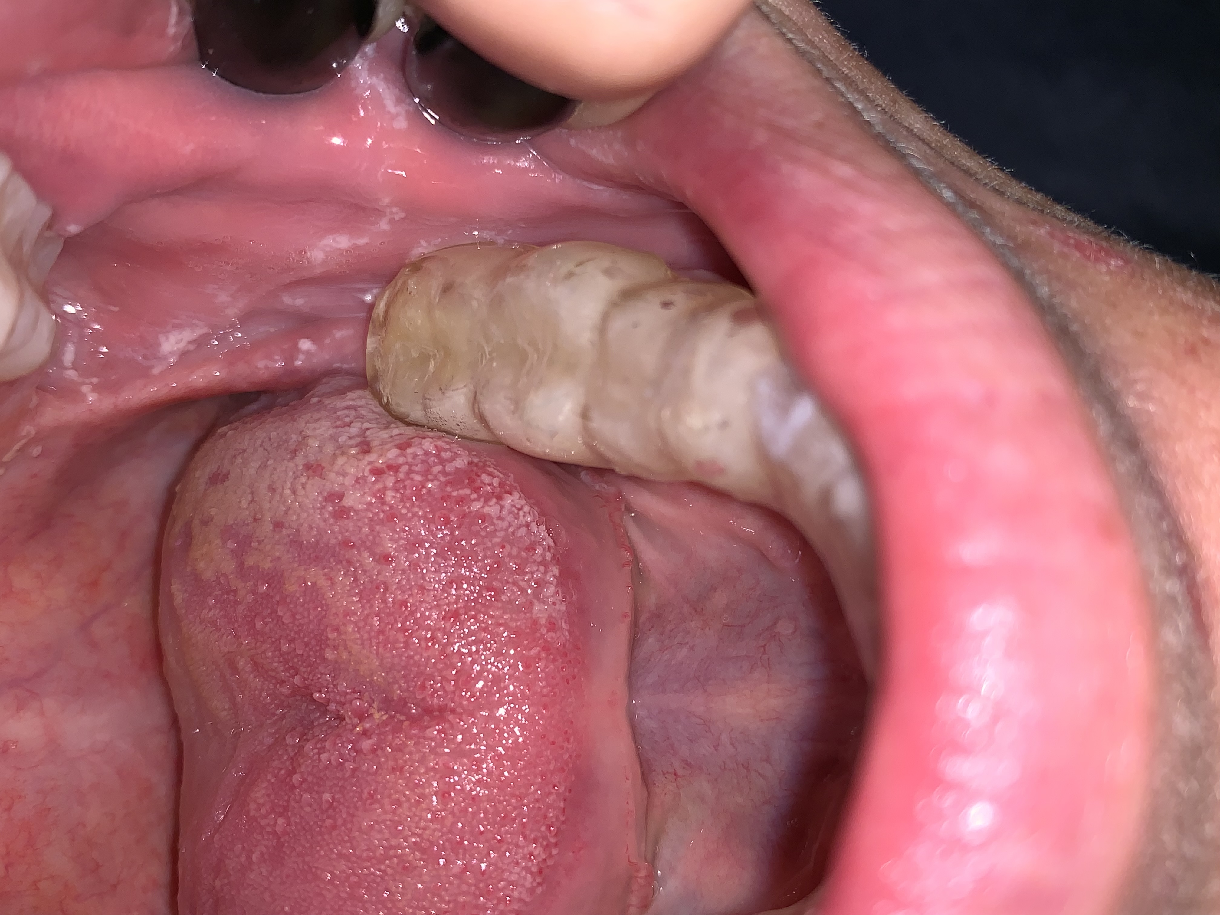 Was sind das für weiße Flecken in meinem Mundraum? (Gesundheit und Medizin, mundschleimhaut)