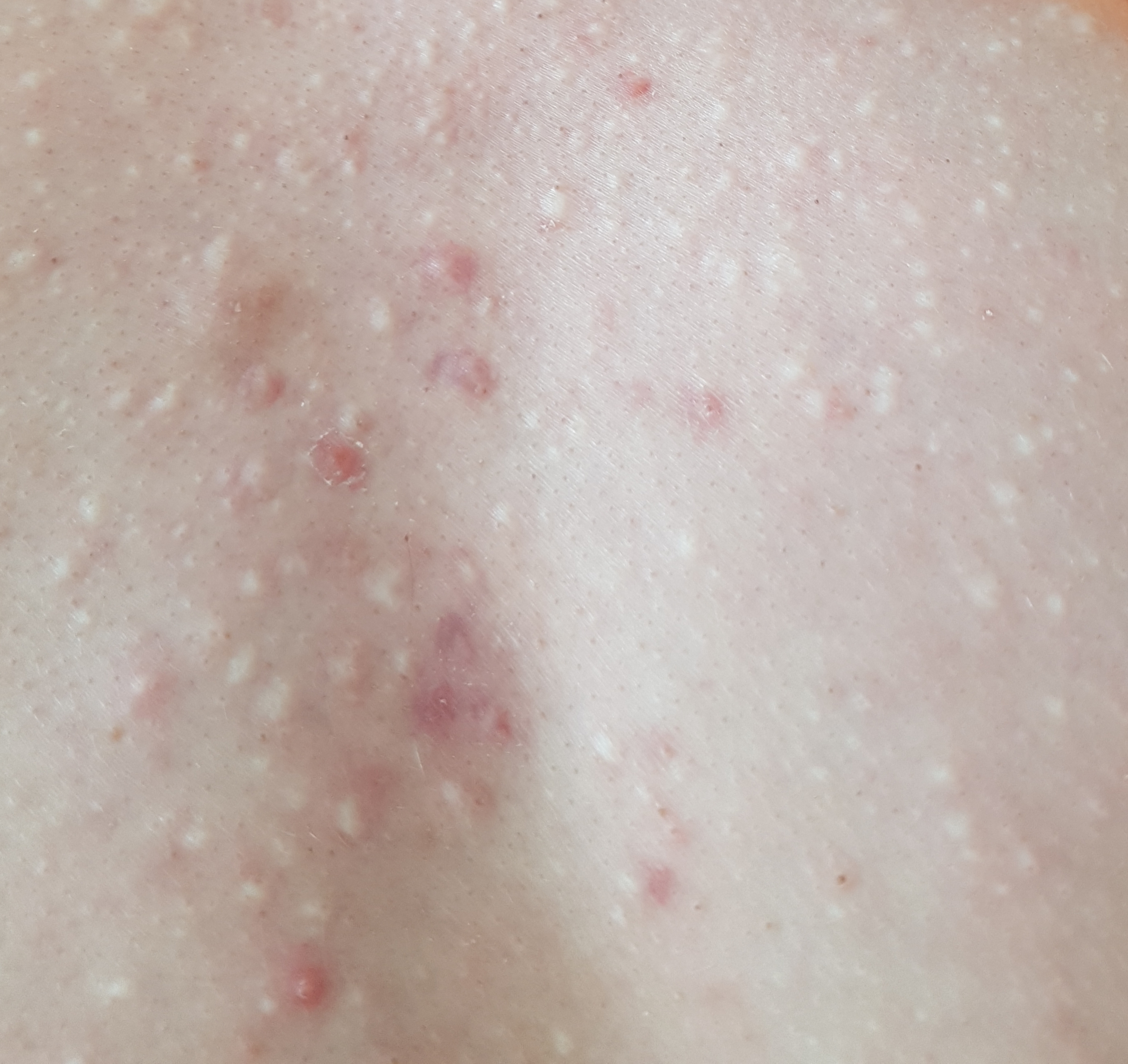 Was sind das für weiße Punkte auf der Brust? (Pickel) Was sind das für weiße Punkte auf der Brust? (Pickel)