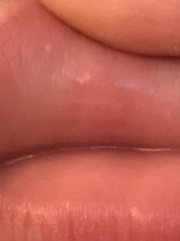 Was Sind Das Fur Weisse Punkte In Meiner Lippe Gesundheit Und Medizin Gesundheit Sex Was Sind Das Fur Weisse Punkte In Meiner Lippe Gesundheit Und Medizin Gesundheit Sex