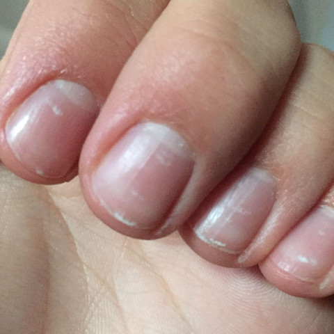Was Sind Das Fur Weisse Stellen Im Fingernagel Gesundheit Medizin Kosmetik