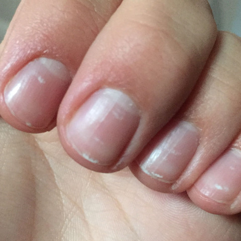 was sind das fur weisse stellen im fingernagel gesundheit medizin kosmetik