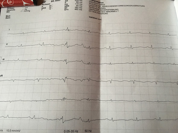 Was sind das für Zacken im ekg? (Gesundheit, Arzt, Krankheit)