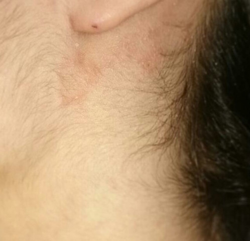 Haut -hals - (Gesundheit, Medizin, Haut)