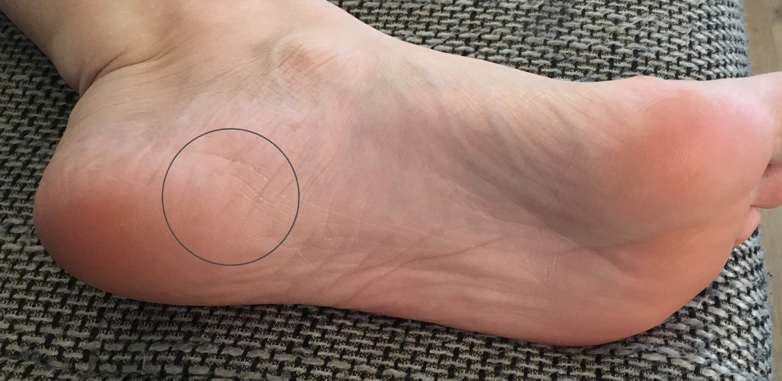 Was Sind Das Plotzlich Fur Schmerzen An Der Ferse Fussschmerzen Was Sind Das Plotzlich Fur Schmerzen An Der Ferse Fussschmerzen