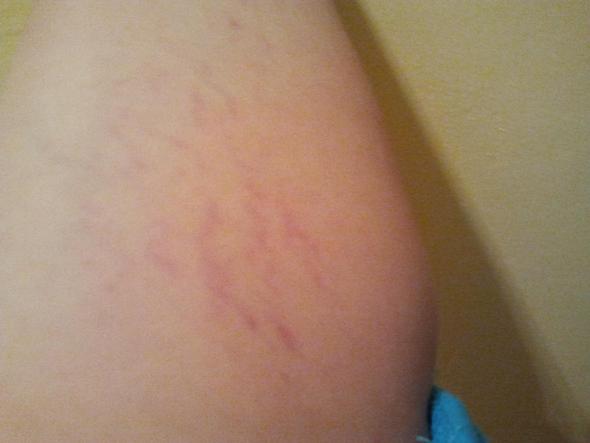 Was Sind Dass Fur Streifen Auf Meinem Oberarm