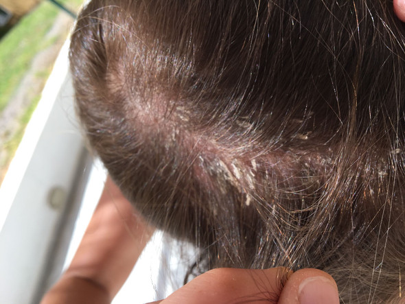 Was Sind Deine Tipps Oder Erfahrungen Gegen Sehr Starke Schuppen Flechten Was Sind Deine Tipps Oder Erfahrungen Gegen Sehr Starke Schuppen Flechten