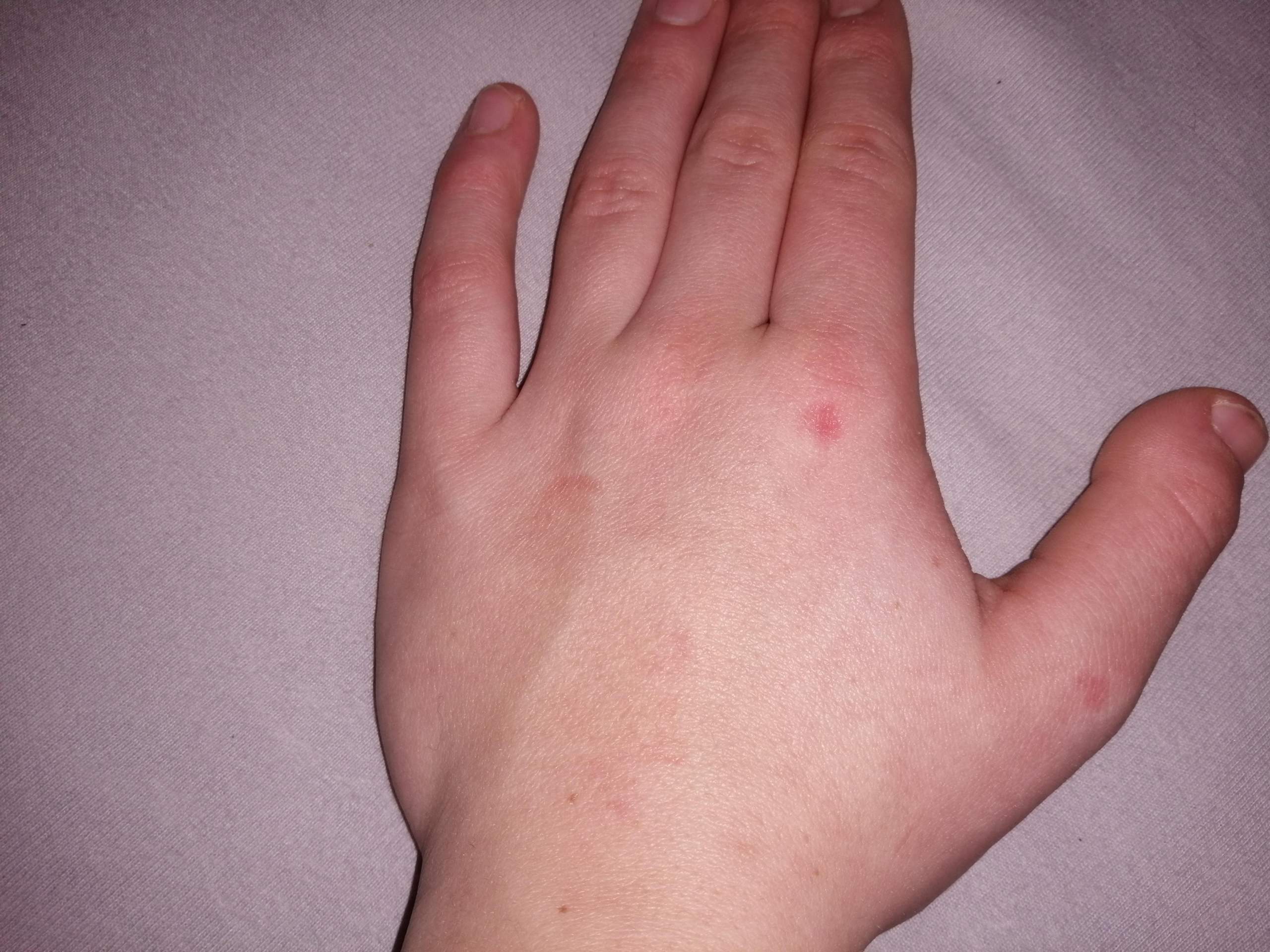 Was bedeuten die roten Flecken an meiner Hand? (Gesundheit) Was bedeuten die roten Flecken an meiner Hand? (Gesundheit)