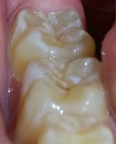 Weiße Spuren - (Zähne, Zahnarzt, Flecken)