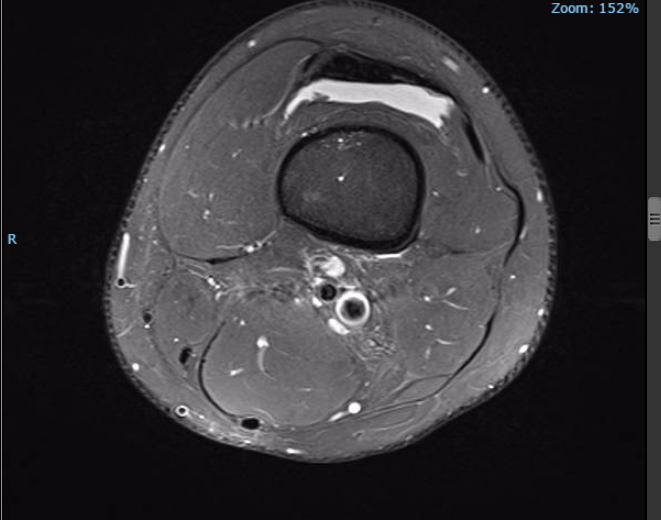 Was sind diese Bläschen im Knie auf dem MRT-Bild ...