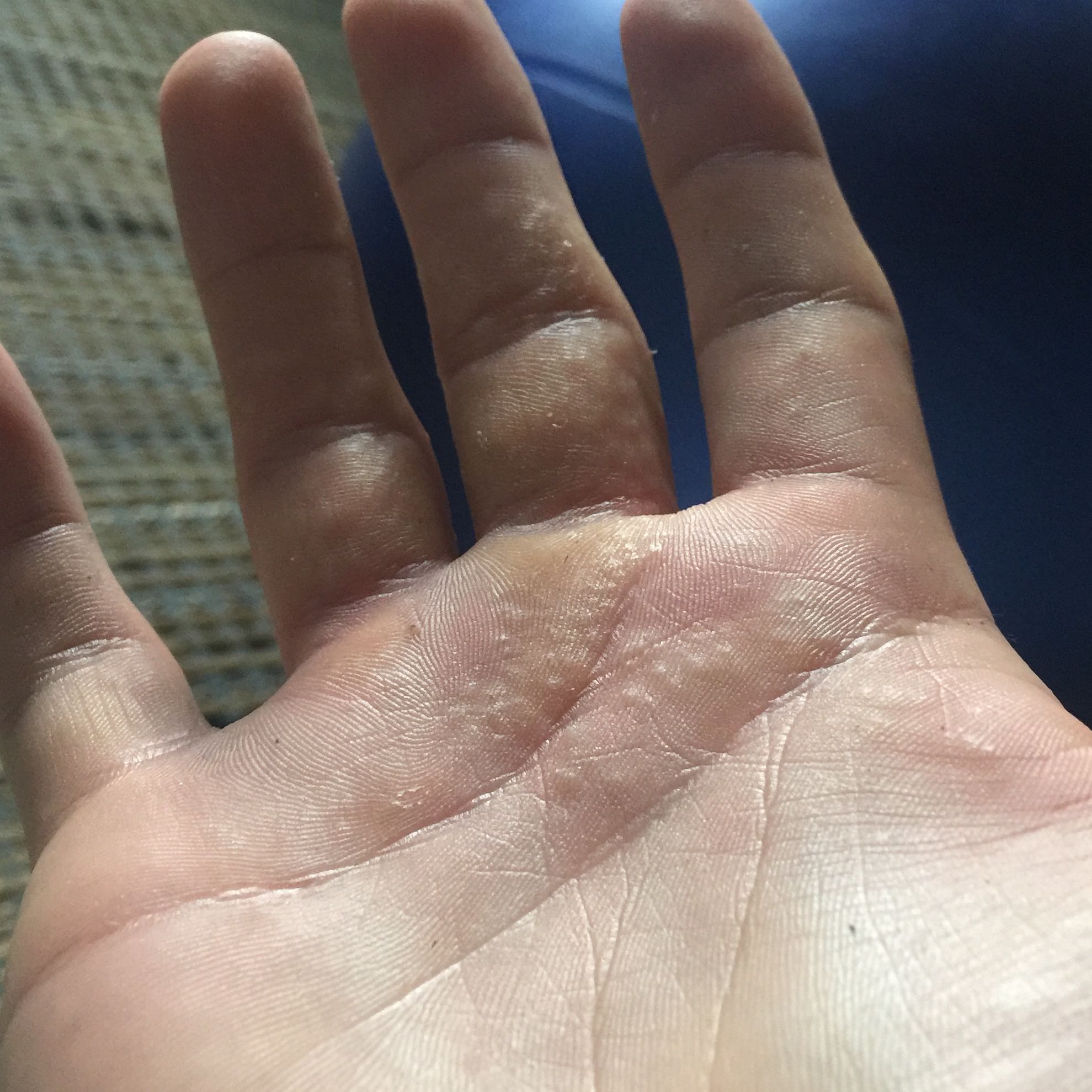 Was sind diese Bläschen? (Gesundheit, Juckreiz)