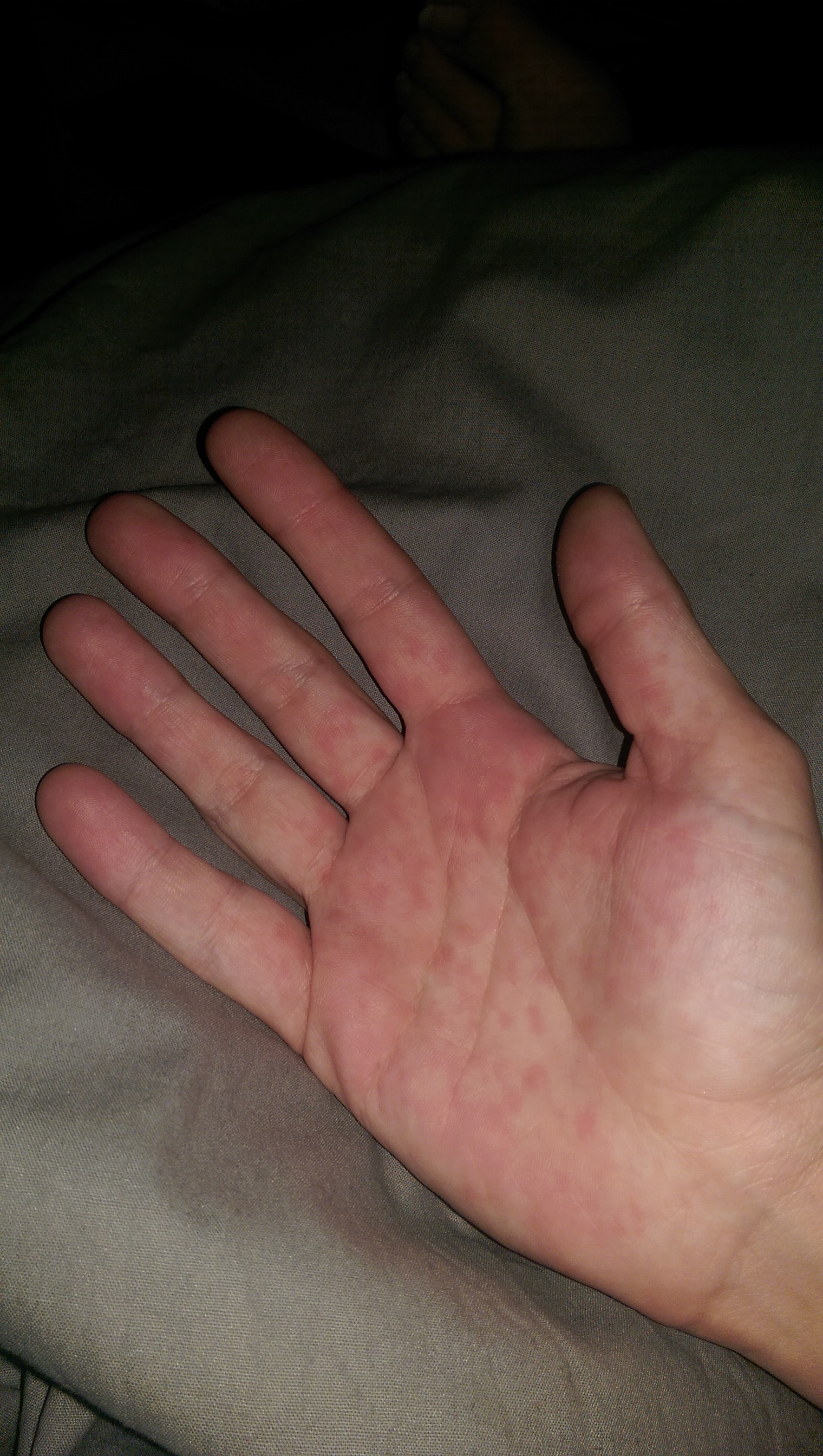 Was Sind Diese Flecken Meine Handinnenfl chen Schmertzt Schmerzen Hand was-sind-diese-flecken-meine-handinnenfl-chen-schmertzt-schmerzen-hand