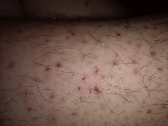 Was Sind Diese Flecken Auf Meine Beine Mit Bild Pickel Was Sind Diese Flecken Auf Meine Beine Mit Bild Pickel