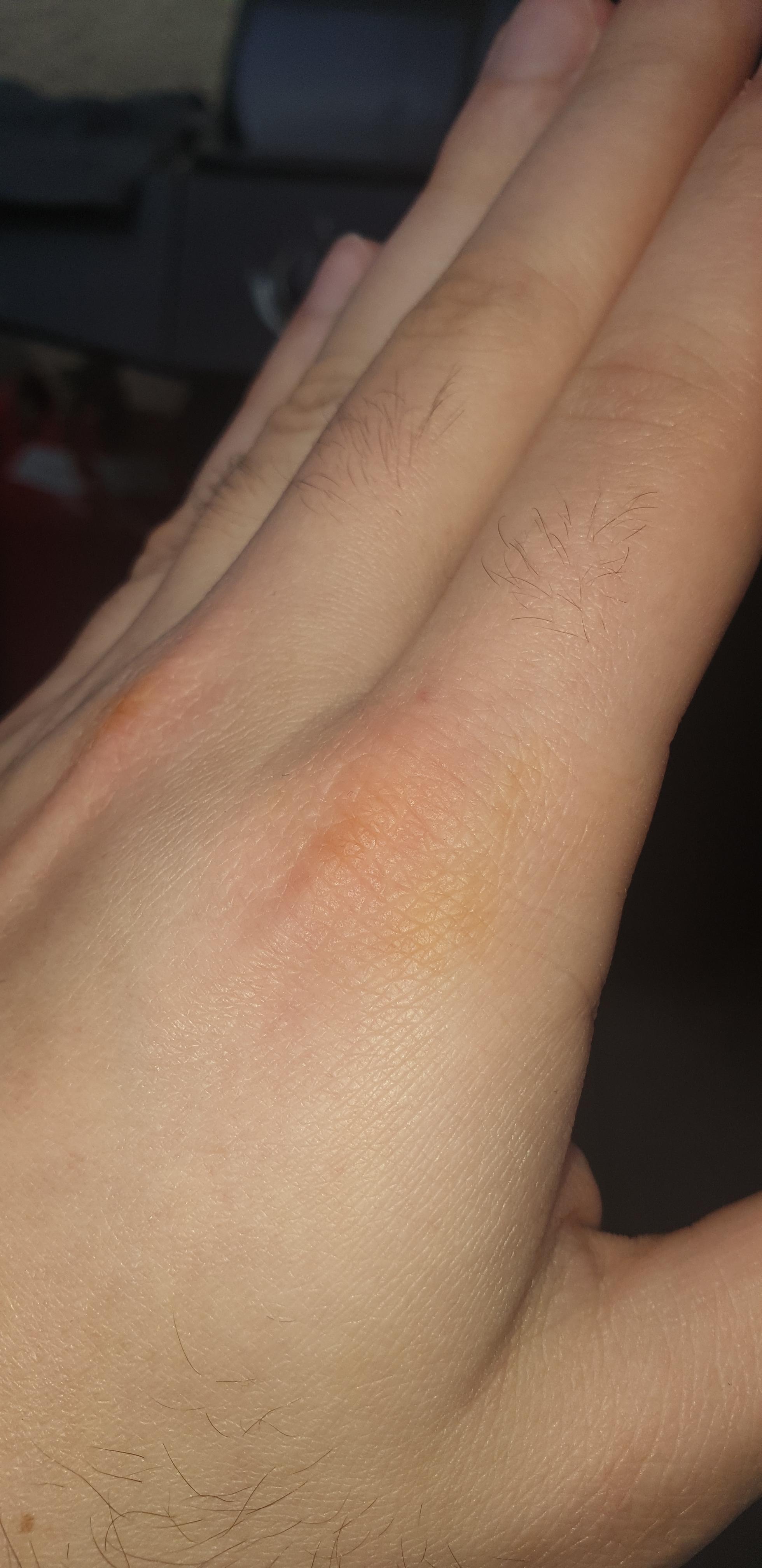 Was sind diese gelben Flecke auf/in meiner Haut? (Medizin, Hand)