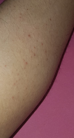 Was Sind Dass Fur Pickel An Meinen Beinen Haut Beine Hautpflege