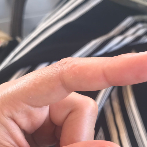 Finger - (Haut, Pickel, Hautpflege)