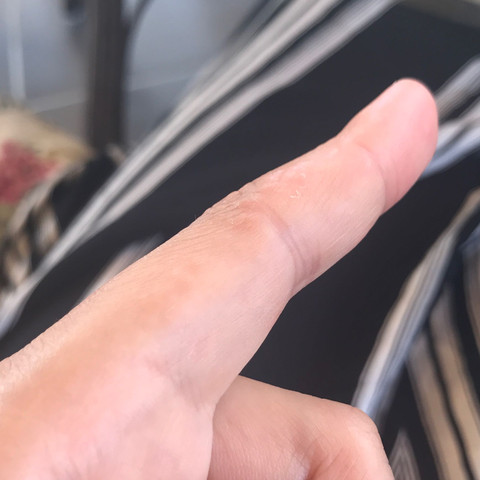 Finger - (Haut, Pickel, Hautpflege)