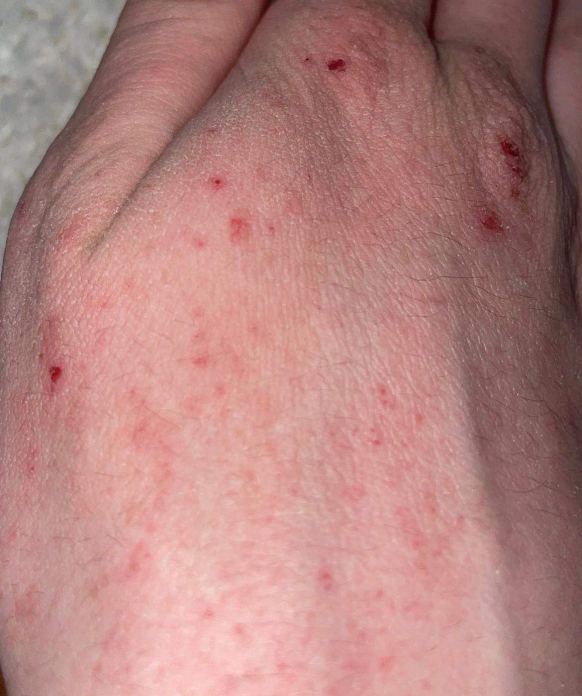 Was sind diese Pickel an meiner Hand? (Gesundheit und Medizin, Haut, Juckreiz) pickel hand