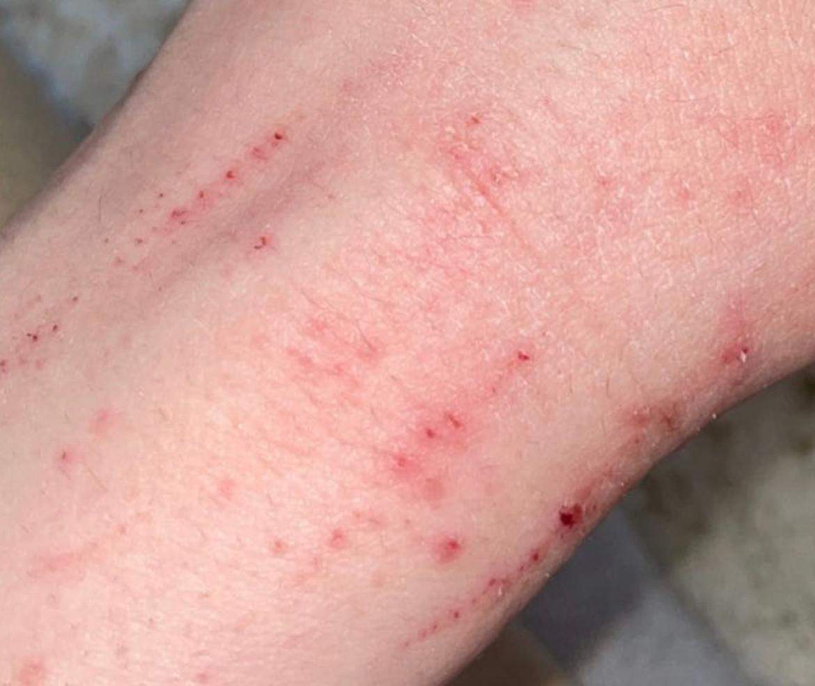 Was sind diese Pickel an meiner Hand? (Gesundheit und Medizin, Haut, Juckreiz) pickel hand