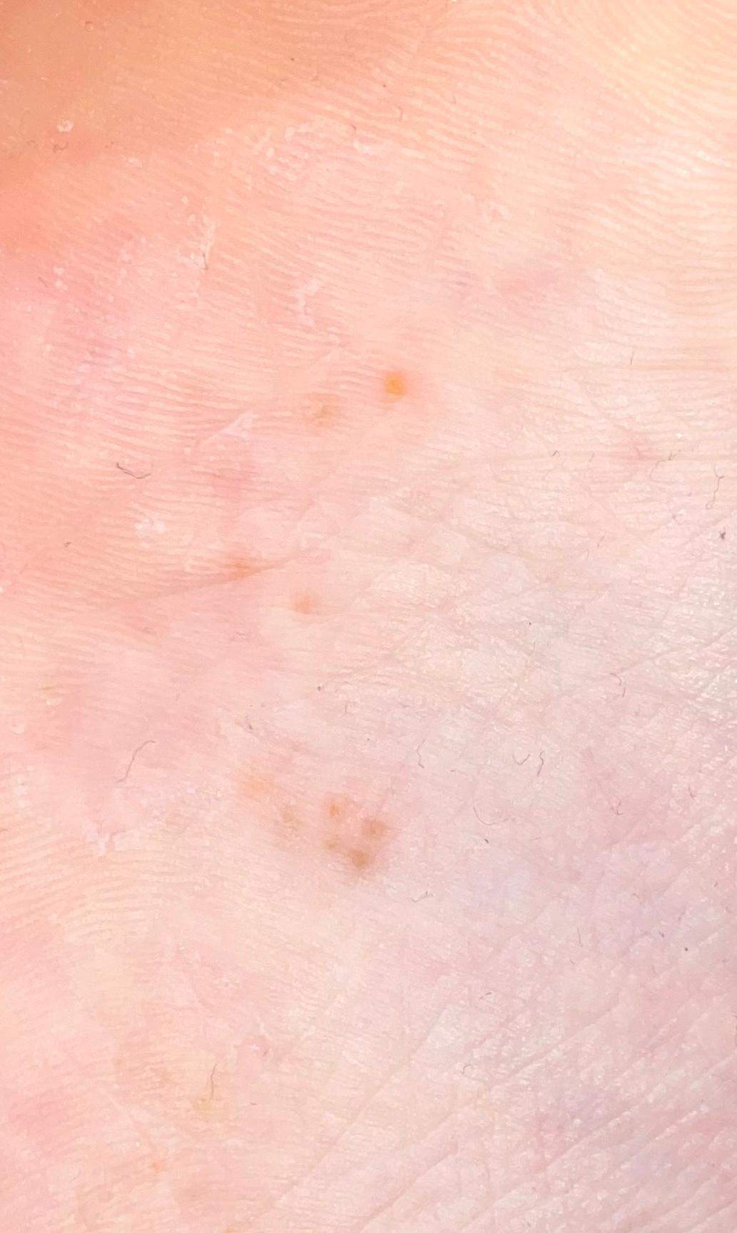 Was sind diese Punkte? (Gesundheit und Medizin, Haut)