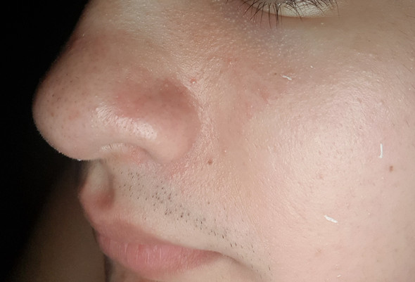 Was Sind Diese Rotungen Unreine Haut Gesundheit Und Medizin Beauty Pickel