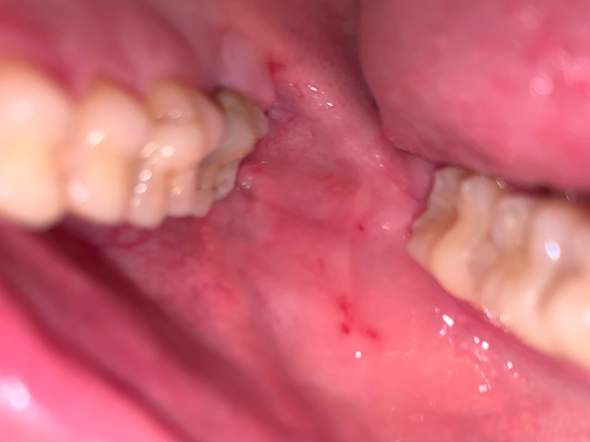 Was Sind Diese Roten Punkte Im Mund Gesundheit Und Medizin Wangen Rote Punkte Was Sind Diese Roten Punkte Im Mund Gesundheit Und Medizin Wangen Rote Punkte