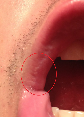 Was Sind Diese Weissen Punkte Am Mundwinkel Gesundheit Lippe Seltsam Was Sind Diese Weissen Punkte Am Mundwinkel Gesundheit Lippe Seltsam