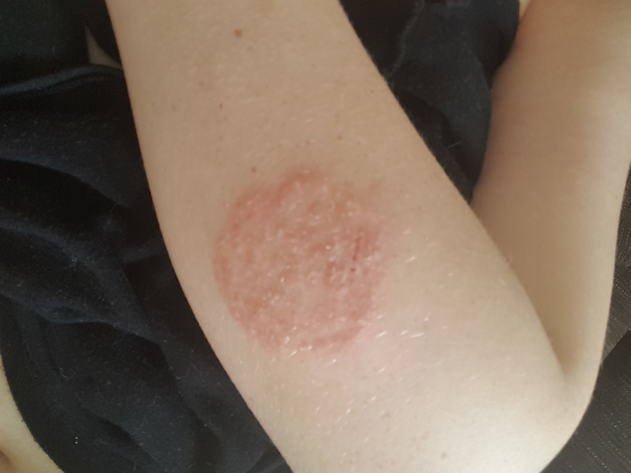 Was soll ich gegen meinen kreisförmigen juckenden \