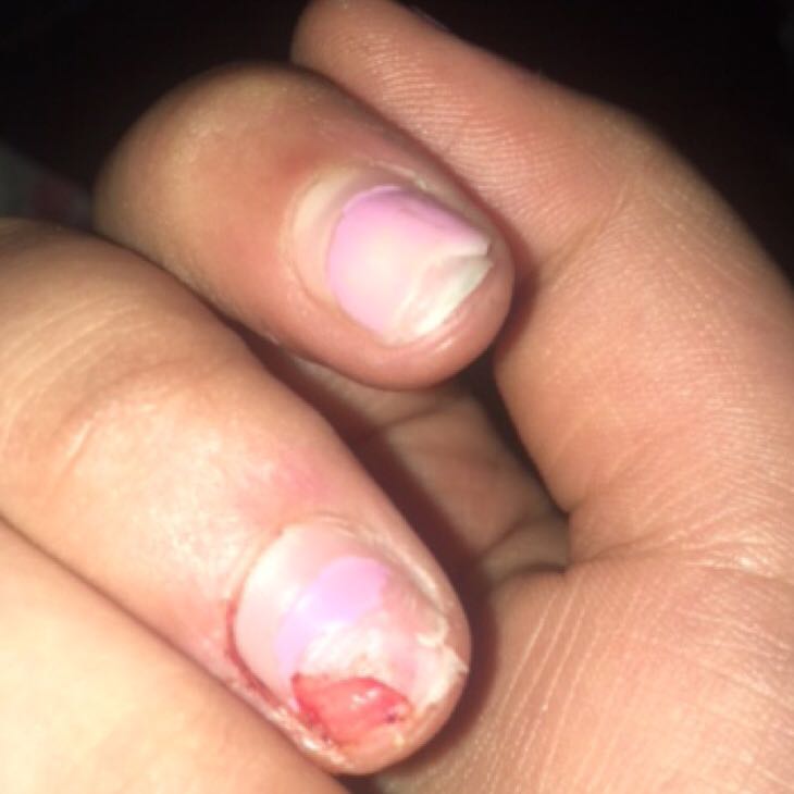 Was Soll Ich Machen Wen Mein Natur Nagel Bis Uber Die Halfte Abgebrochen Ist Blut Nagel Gelnagel