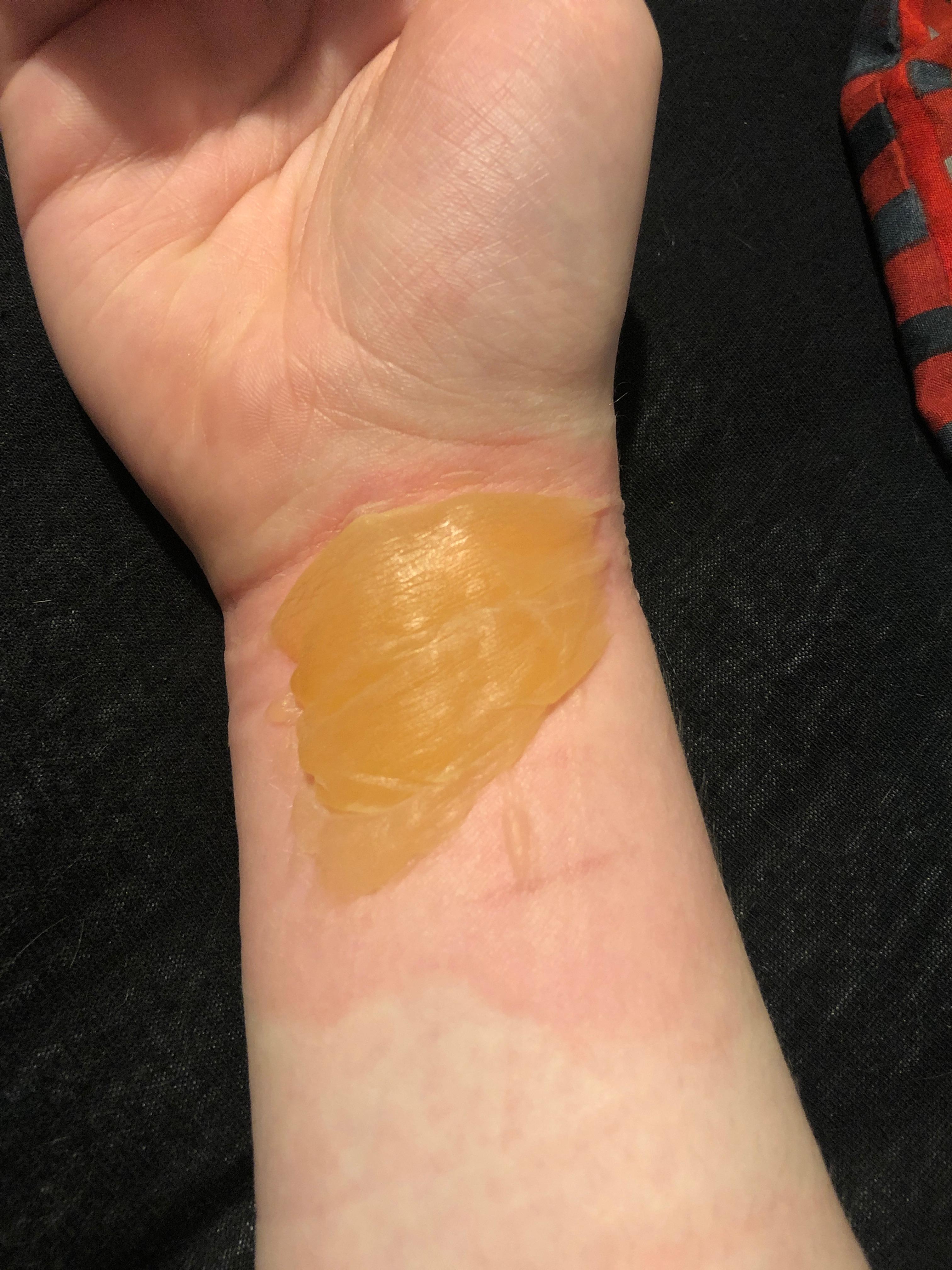 Was soll ich mit dieser Brandblase tun? (Gesundheit und Medizin, Gesundheit, Verbrennung)