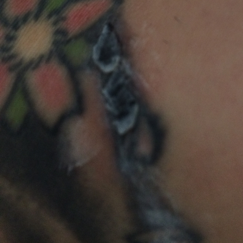 Was Soll Ich Tun Tattoo Verbrannt Medizin Verbrennung