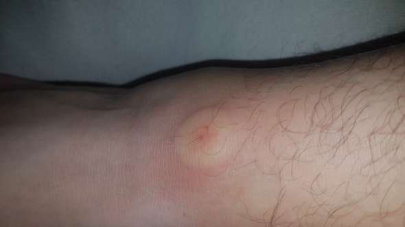 Was Sticht Mich Immer Gesundheit Und Medizin Insektenstich Mueckenstich