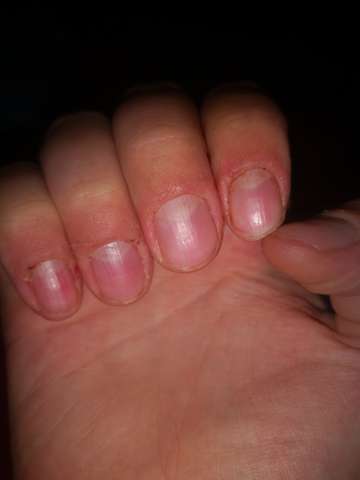 Was Stimmt Bei Meinen Fingernageln Nicht Krankheit Haut Fingernagel
