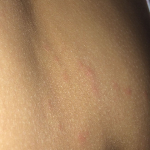 Was Tuen Gegen Hautausschlag Am Bauch Und Rucken Gesundheit Und Medizin Pubertat Juckreiz Was Tuen Gegen Hautausschlag Am Bauch Und Rucken Gesundheit Und Medizin Pubertat Juckreiz