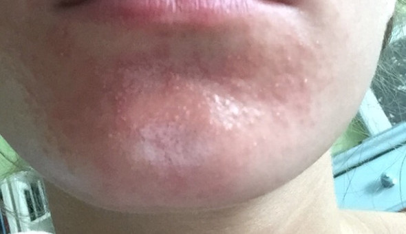 Was Tuen Gegen Starken Ausschlag An Kinn Nase Gesicht Rotung Was Tuen Gegen Starken Ausschlag An Kinn Nase Gesicht Rotung