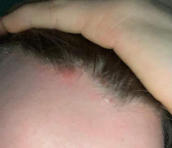 Was Tun Gegen Schuppen Und Rote Kopfhaut Gesundheit Und Medizin Was Tun Gegen Schuppen Und Rote Kopfhaut Gesundheit Und Medizin