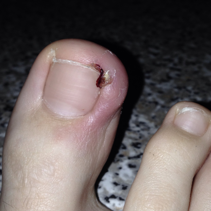 was tun bei dieser Nagelbettentzündung, steht unter Eiter, und wie