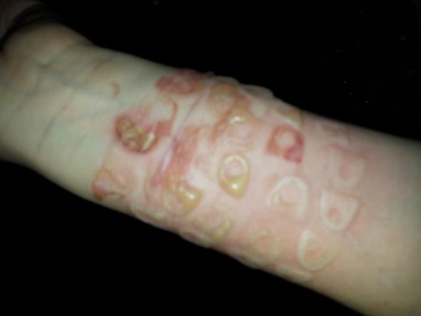 Was Tun Bei Dieser Verbrennung Gesundheit Was Tun Bei Dieser Verbrennung Gesundheit