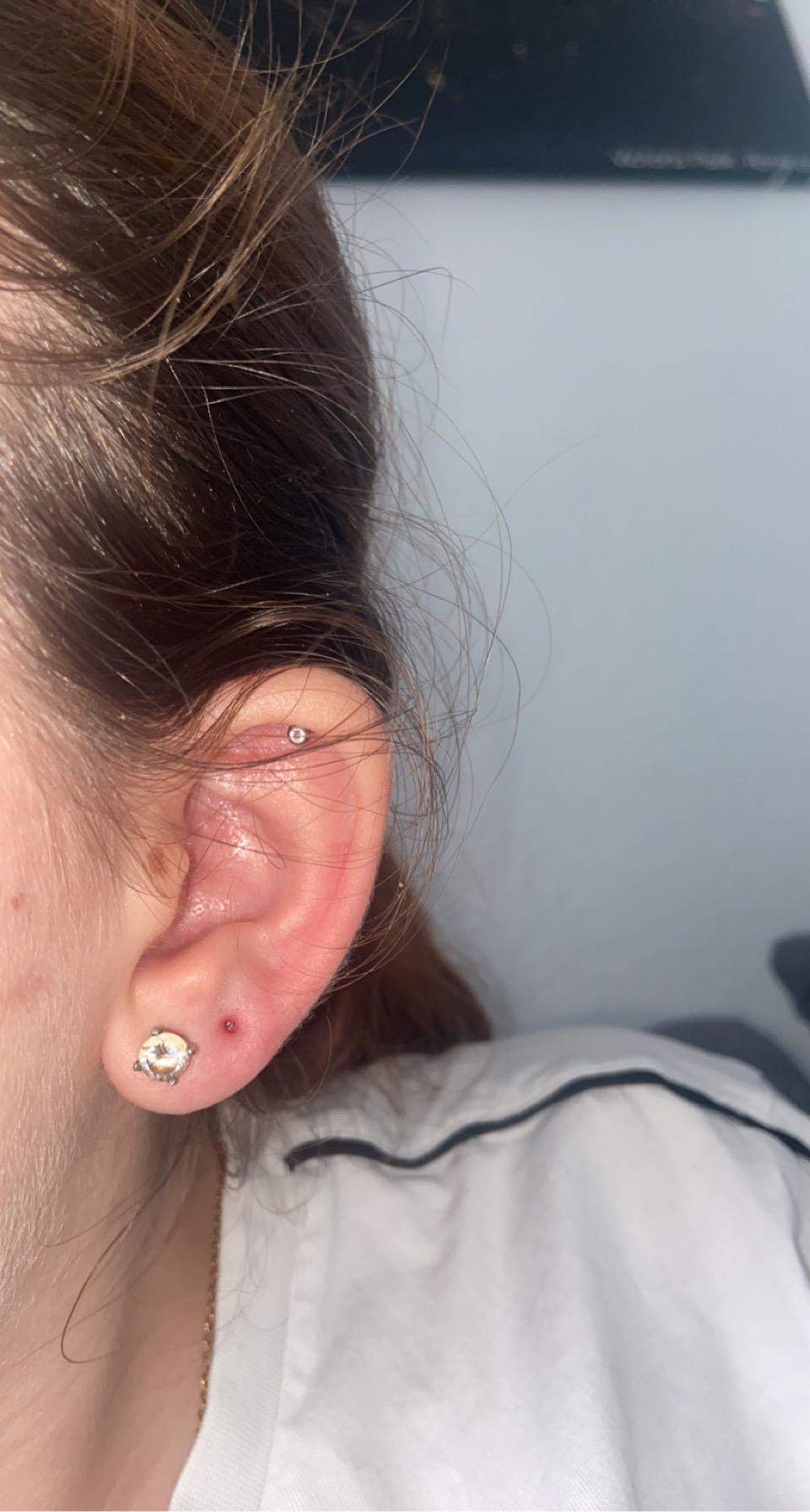 Was tun bei entzündeten Ohrloch? (Ohrringe, Piercingschmuck, Ohrpiercing)