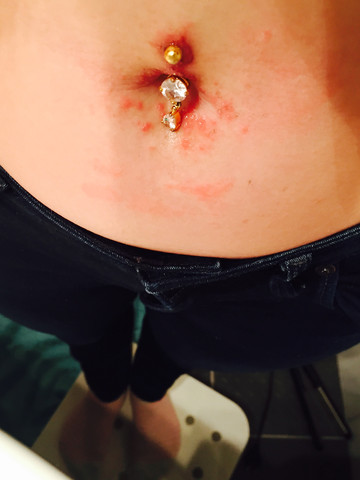 Bauchnabelpiercing entzündet kamillentee Bauchnabelpiercing entzündet kamillentee